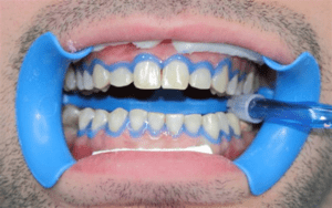 Blanchiment des dents 1