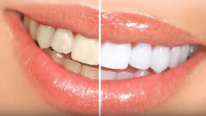 Facettes dentaires 2