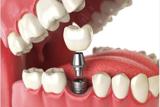Prix implant en Turquie : une comparaison détaillée des coûts selon les interventions dentaires