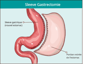 Sleeve gastrectomie 1