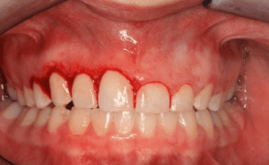 Gingivectomie
