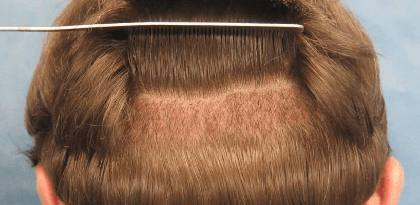 Prix Greffe de Cheveux Turquie : Guide Complet des Coûts et Options 2024
