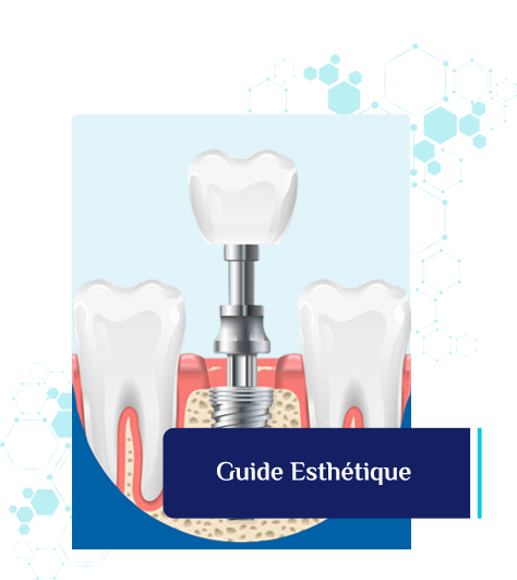 implant-dentaire-porcelaine