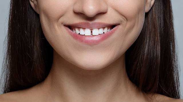 Comment combler un espace entre deux dents naturellement ?