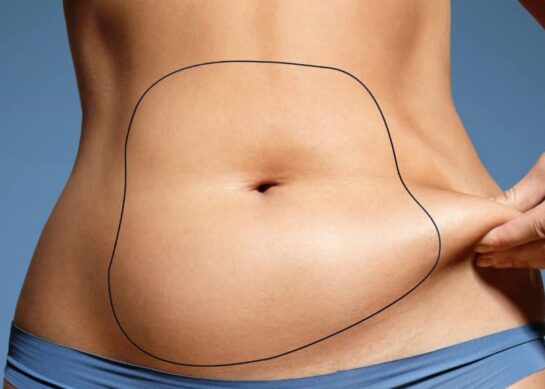 Comment retendre la peau du ventre après liposuccion ?