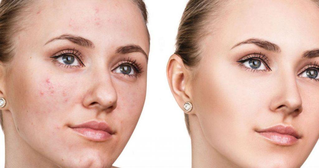 Comment éliminer les acnés ?