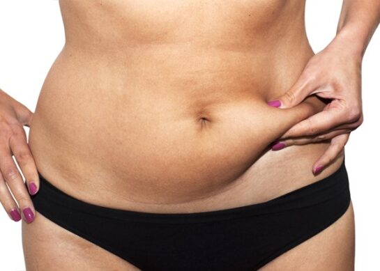 Combien de temps pour dégonfler après une liposuccion du ventre ?