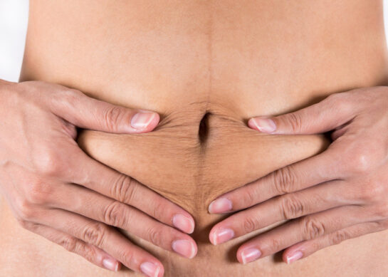 Cicatrisation nombril après accouchement par césarienne : faire t-il faire vraiment une ombilicoplastie ?